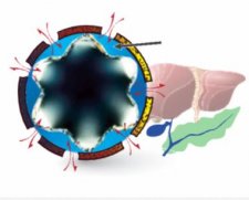 BVM Medical EGIS Flower Stent | Which Medical Device